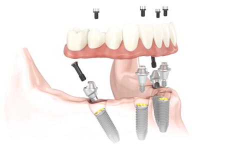 All on 4 implants Newcastle