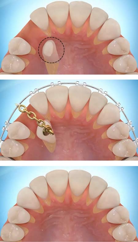 Exposure of impacted teeth by Newcastle surgeons at Wood Street Specialists