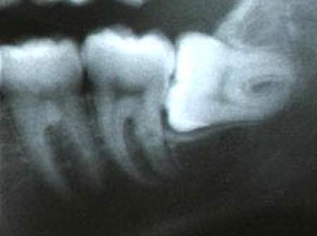 x-ray imaging of an impacted wisdom tooth requiring extraction (removal)
