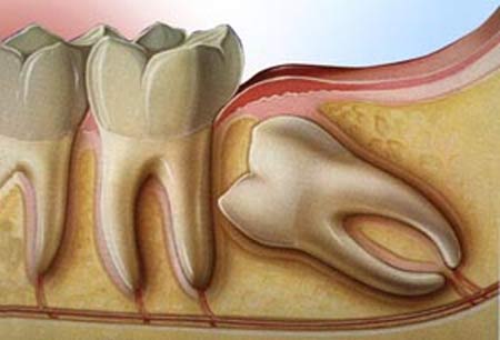 wisdom teeth surgery Newcastle - wisdom teeth removal by oral surgeon