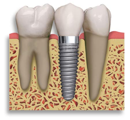 Dental Implants Newcastle with Wood St Specialists Dr Mehanna & Dr Yang