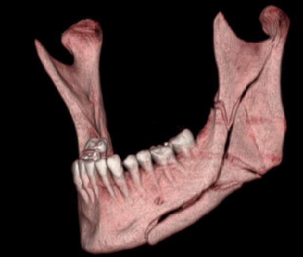 Broken Jaw treatment and surgery Newcastle