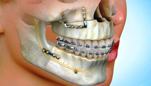 Corrective Jaw Surgery Newcastle, also known as Orthognathic Surgery