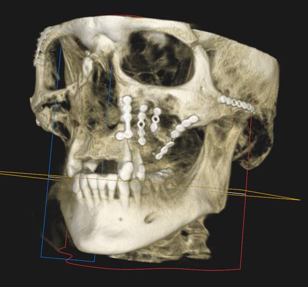 Facial Trauma - surgery for facial injuries including broken jaws and facial lacerations in Newcastle