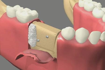 oral bone grafting surgery