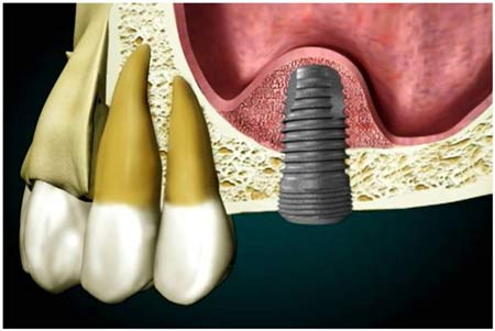 Sinus Lift surgery Newcastle